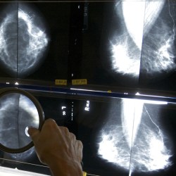 Mammograms-Explainer